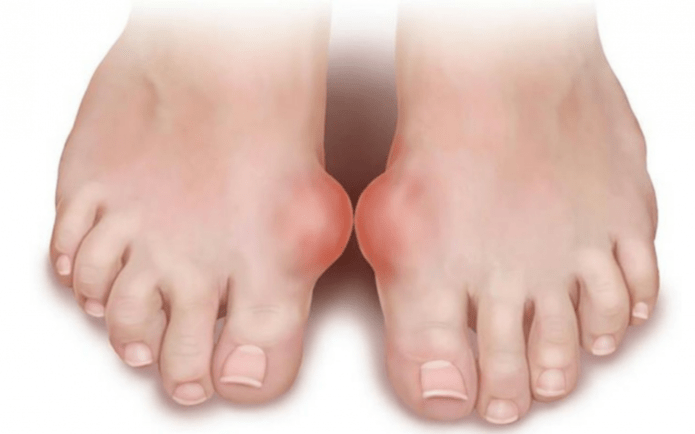 Deformität des Fußes als Ursache für das Auftreten von Pilzen an den Beinen