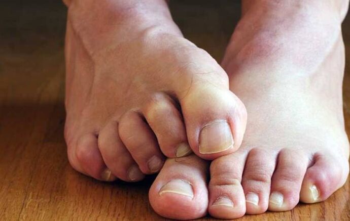 Symptome von Plattenepithel an den Füßen