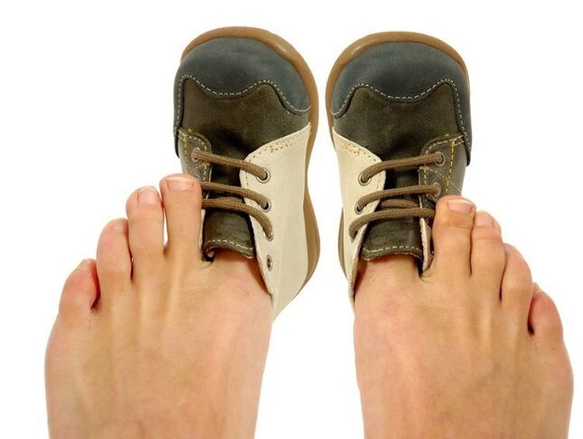 enge Schuhe als Ursache für Pilze zwischen den Zehen