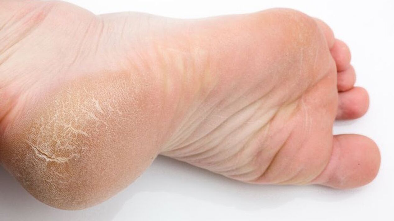 Pilz auf der Haut der Füße