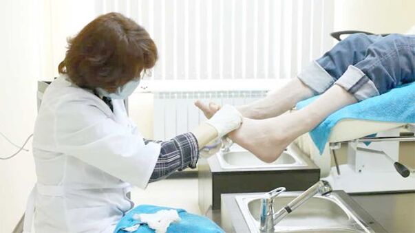 Ein Dermatologe behandelt Zehennagelpilz