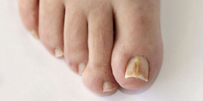 Nagelpilz