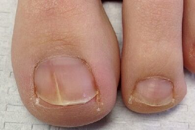 Fingernagelpilz