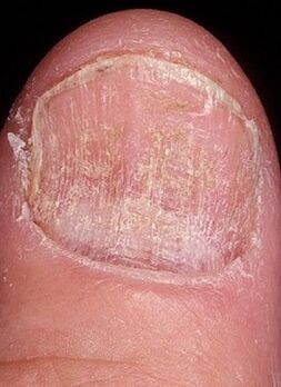 Mykose des Nagels
